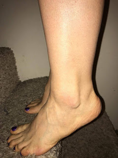 Roller Derby Ankle Strengthening